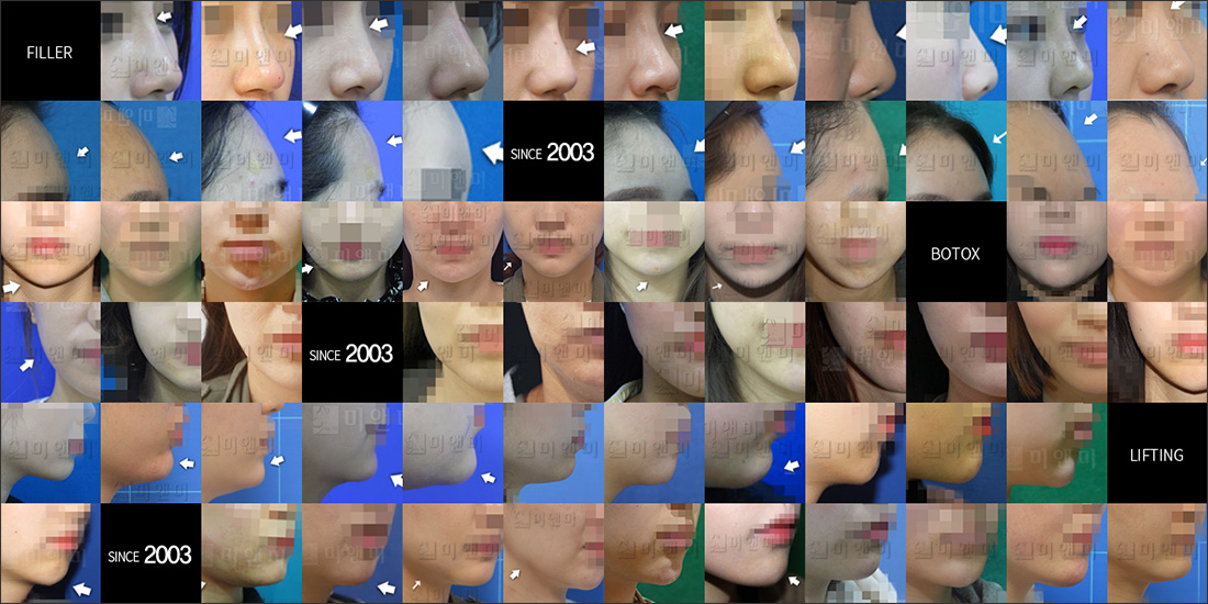 SINCE 2003 MI&MI, 시술후사진모음 광명유셀레이저, 철산역유셀레이저
