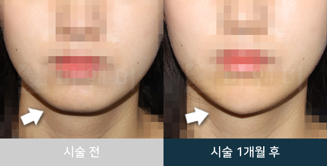 before_Img