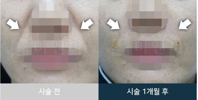 before_Img