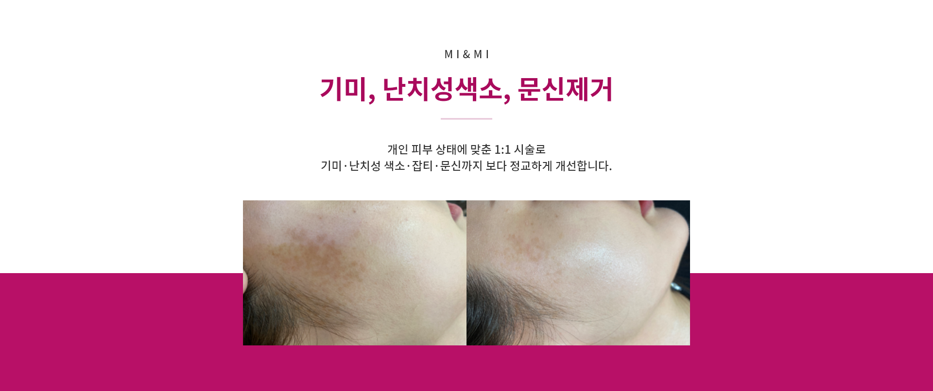 기미, 난치성색소, 문신제거