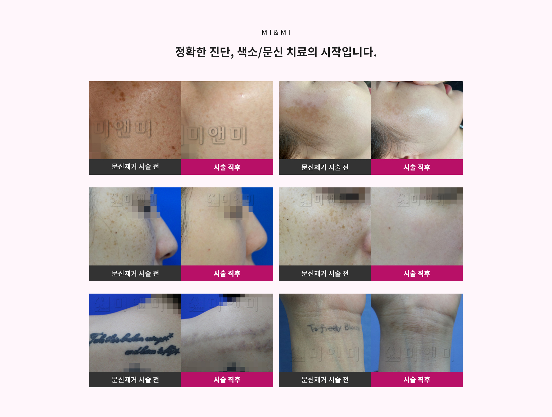 정확한 진단, 색소/문신 치료의 시작입니다.