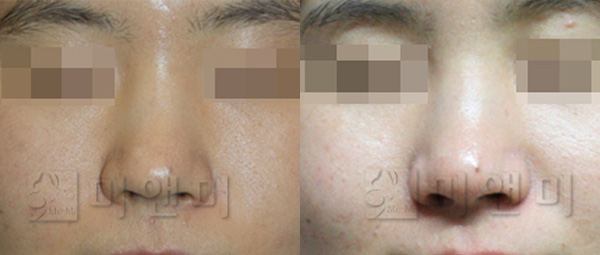 광채, 미백효과 피부결개선 시술전후