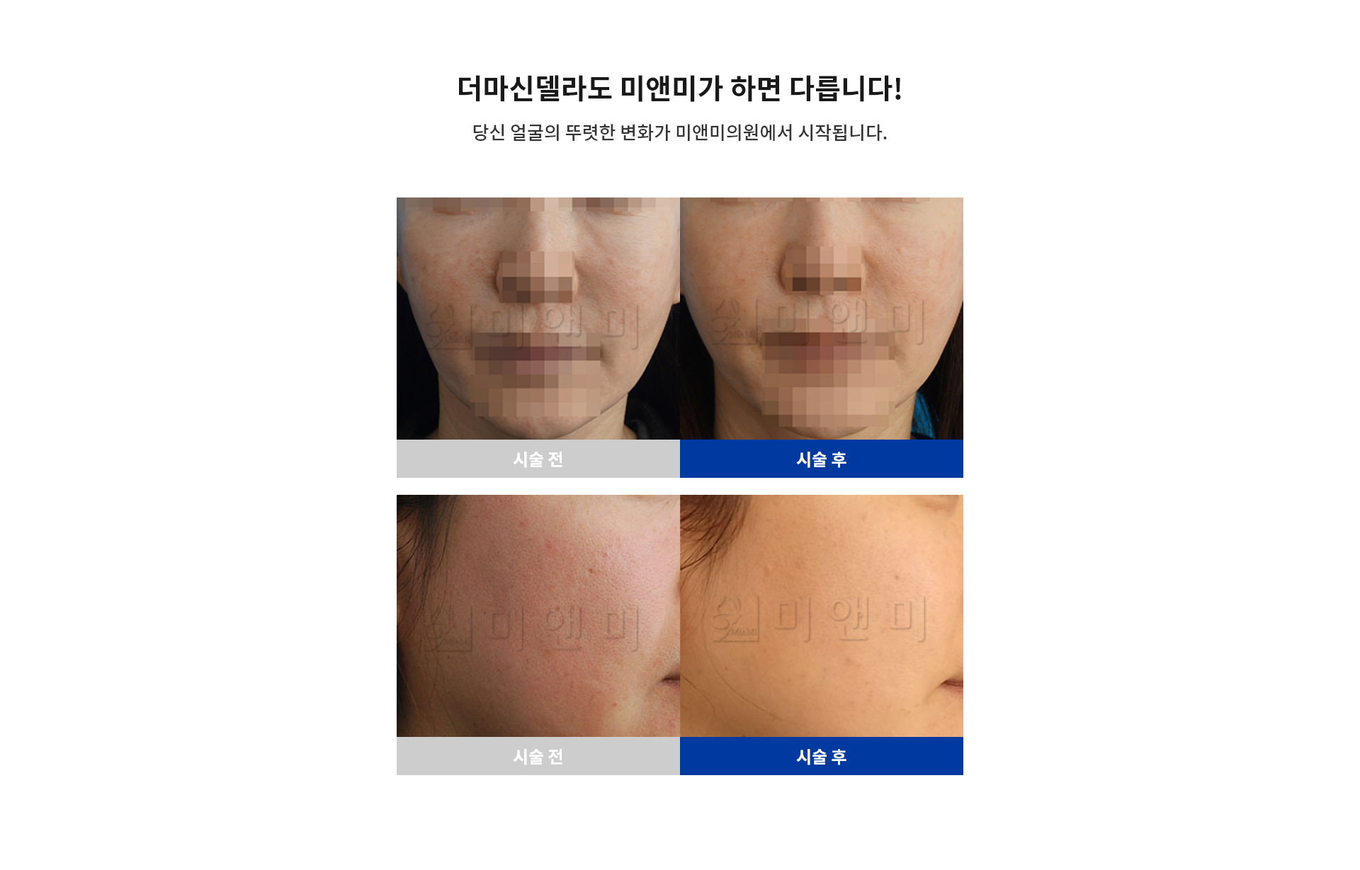 더마신델라 시술전후