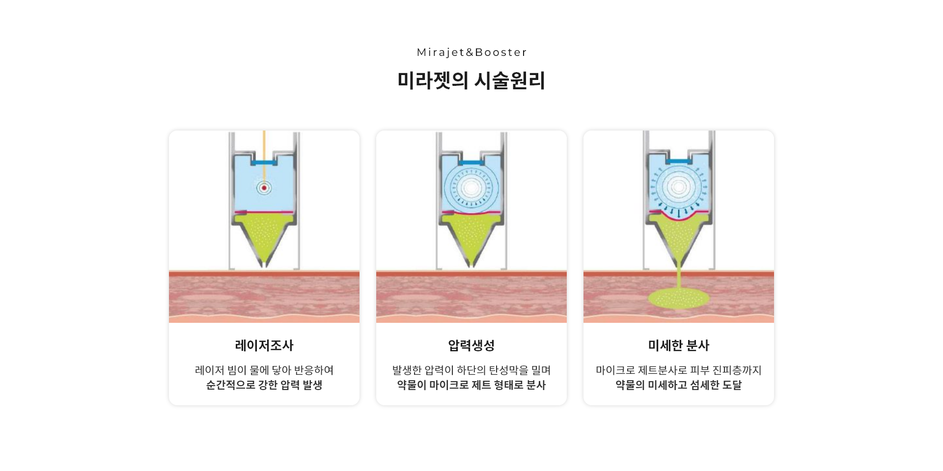 미라젯의 시술원리