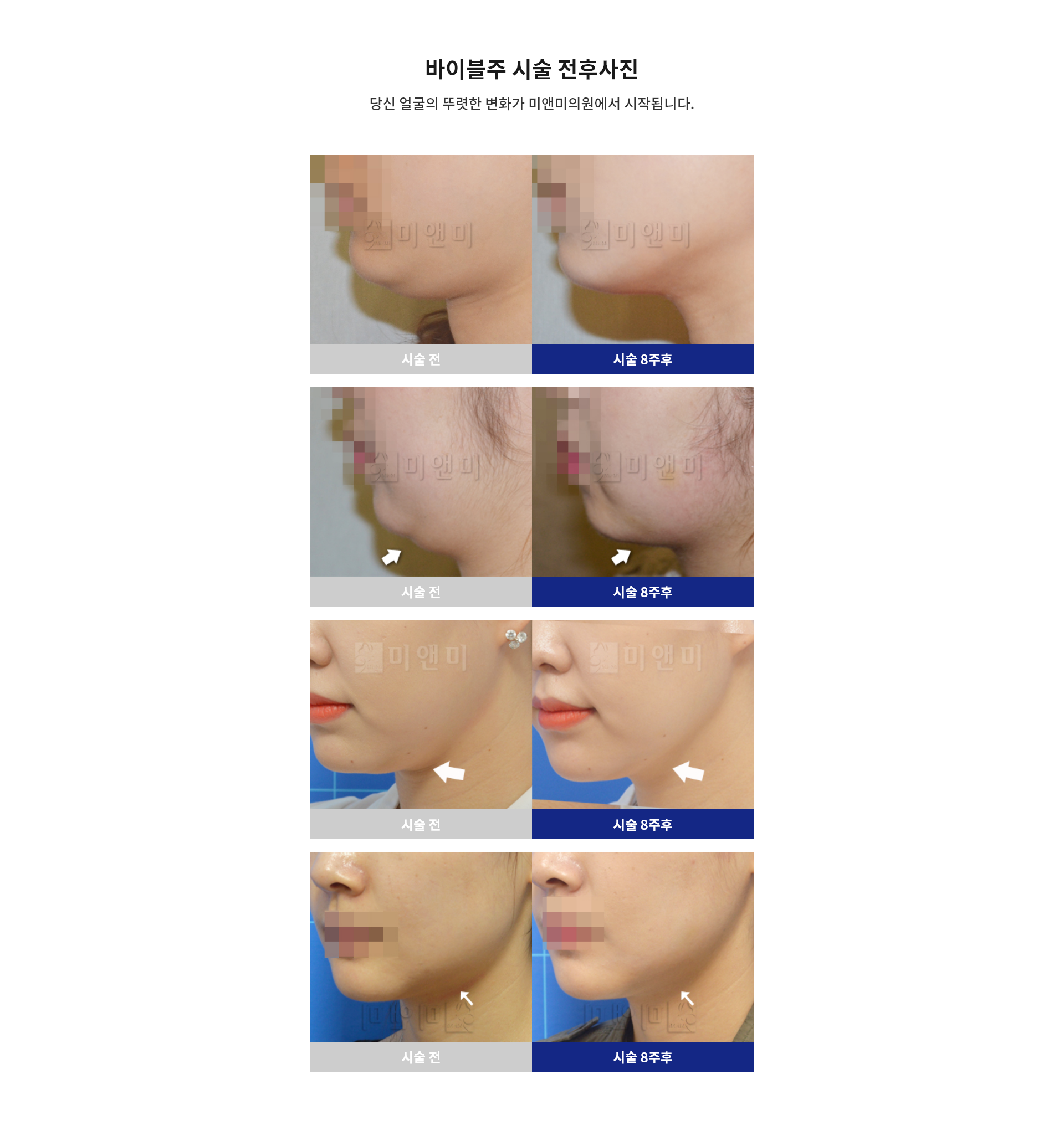 바이블주 시술 전후사진
